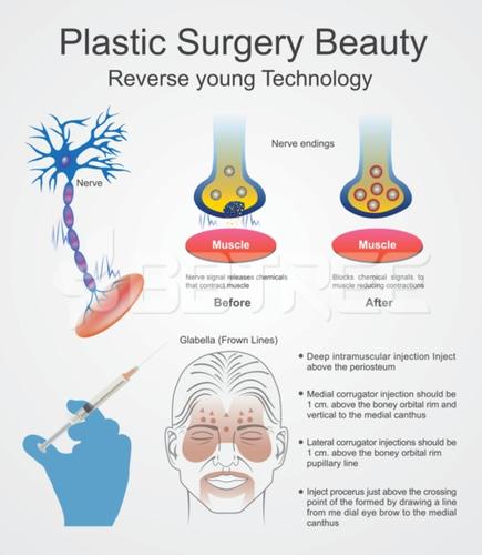 Plastic surgery. Botox.