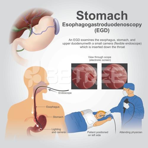 EGD Stomach process. Illustration.