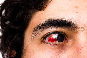 Young man with subconjungtival hemorrhage