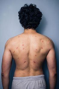 Man with mosquito bites on his back