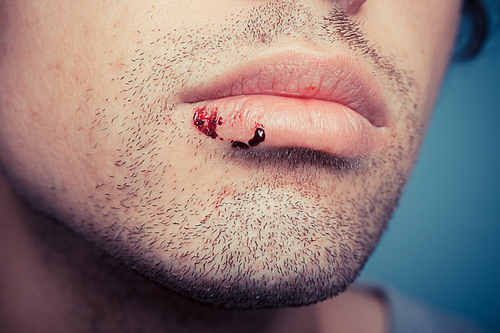 Young man with dried blood from a cold sore on his lip