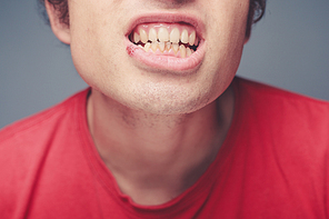 Young man with a cold sore on his lip and plaque on his teeth