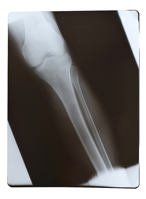 X-Ray leg shot isolated on white
