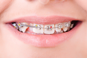 Mouth with brackets braces in medical concept