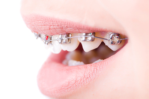 Mouth with brackets braces in medical concept