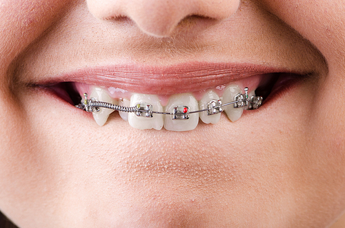 Mouth with brackets braces in medical concept