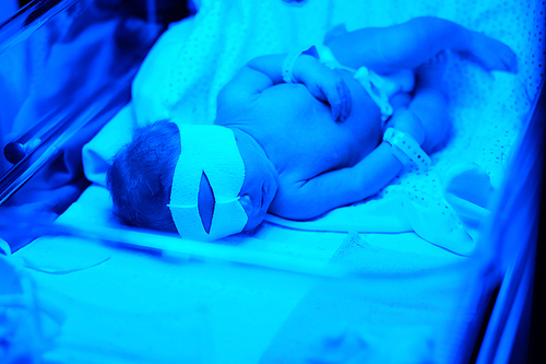 Two days old newborn baby having photo theraphy under blue UV light