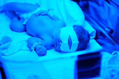 Two days old newborn baby having photo theraphy under blue UV light