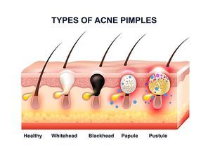 Colored skin acne anatomy composition with types of acne pimples before and after vector illustration