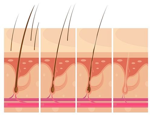 Hair loss storyboard conceptual compositions set with profile macro view of balding scalp skin vector illustration