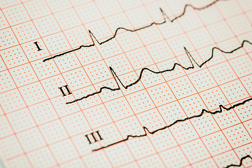 Sinus Heart Rhythm On Electrocardiogram Record Paper