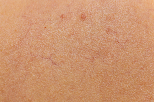 Person having dermatoses on her skin. Skincare problems concept. Close up of dilated capillaries, spider veins, red bumps.