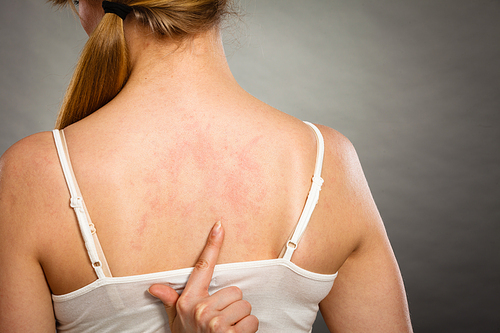 Health problem, skin diseases. Young woman showing her itchy back with allergy rash urticaria symptoms