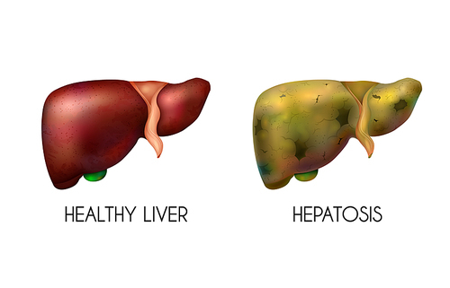 Realistic human internal organs liver healthy normal unhealthy fatty composition with two different colors when the disease is present vector illustration