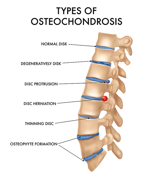 Vertebral column segment spinal  intervertebral hernia osteochondrosis pathology chart realistic medical education anatomy textbook poster vector illustration