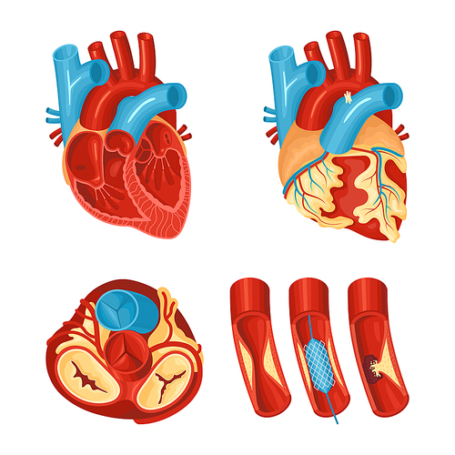 Anatomy of healthy and diseased heart flat set isolated on white  vector illustration