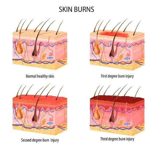 Realistic set of normal and three degree of burns skin structure isolated on white  vector illustration