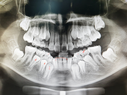 치아 엑스레이 x-ray