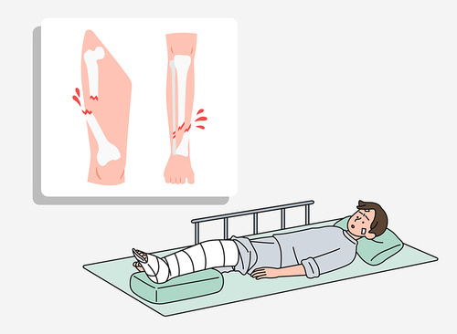 다리부위에 개방골절로 인해 병상에 누워있는 환자 벡터 일러스트