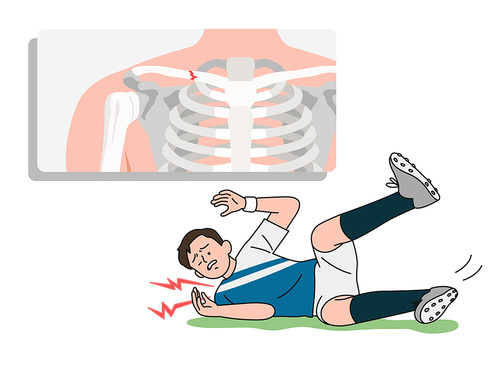 운동중에 넘어져 쇄골 골절 벡터 일러스트