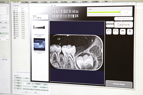 어린이 치아의 엑스레이 사진