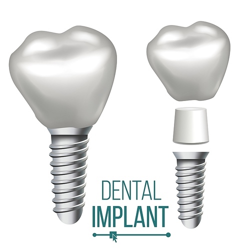 Dental Implant Vector. Implant Structure. Crown, Abutment, Screw Realistic Isolated Illustration
