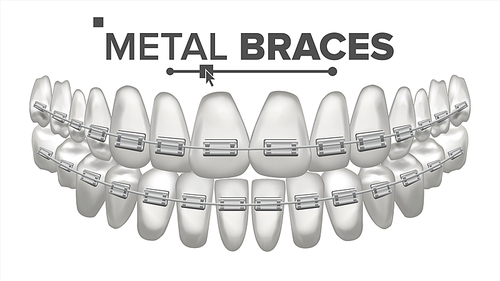 Metal Braces Vector. Human Jaw. Braces On Teeth. Smile With Braces. Realistic Isolated Illustration
