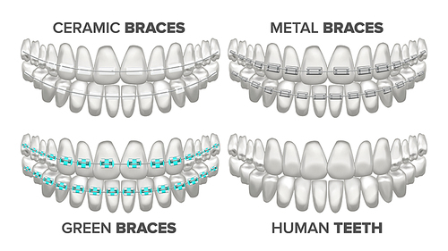 Braces Set Vector. Different Types. Human Jaw. Metal, Ceramic Child Isolated Illustration