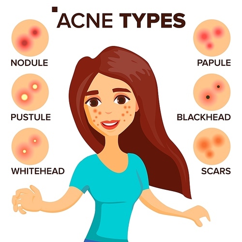 Acne Types Vector. Girl With Acne. Skin Care. Treatment, Healthy. Nodule, Whitehead Isolated Flat Illustration