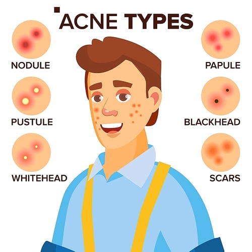 Acne Types Vector. Man With Acne. Facial Skin Problems. Papule, Pustulem Scards. Isolated Flat Cartoon Illustration