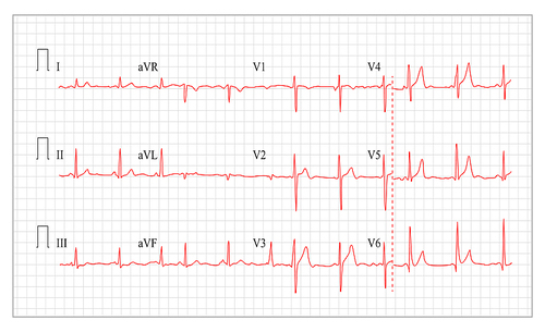 Heart Cardiogram Chart Vector. Set Healthy Heart Rhythm, Ischemia, Infarction. Vitality Heartbeat, Heart Electrocardiogram, Pulse