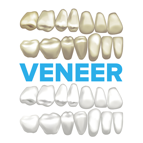 Veneer Vector. Dental Veneer Concept. Medical Banner Design Element. Tooth Before After. Illustration