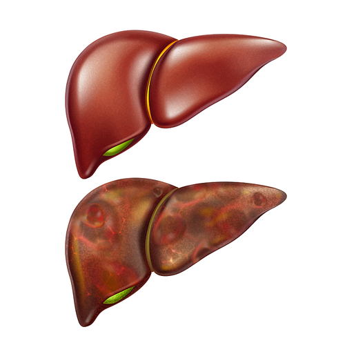Liver Human Healthy And Unhealthy Organ Set Vector. Liver Health Research Health And Disease, Cirrhosis And Cancer, Gastric, Hepatitis And Inflammation. Template Realistic 3d Illustrations