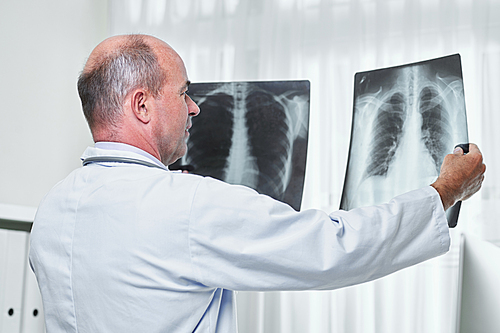General practitioner comparing two chest x-rays of patient with pneumonia