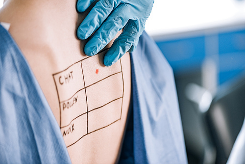 cropped view of allergist touching back of woman with lettering and mark