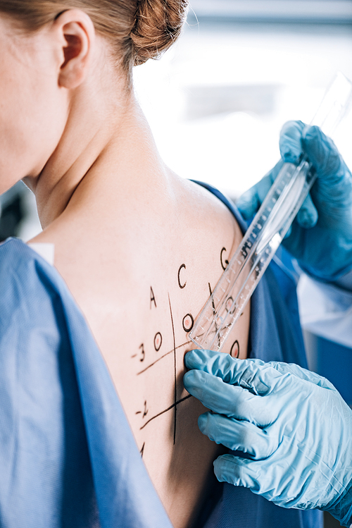 cropped view of allergist in latex gloves holding ruler near patient with marked back