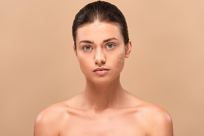 young naked woman with problem skin looking at camera isolated on beige