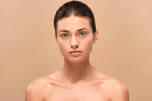 young naked woman with problem skin  isolated on beige