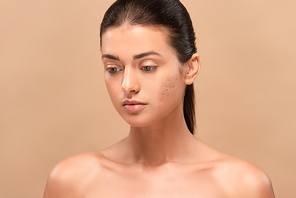 young naked woman with problem skin isolated on beige