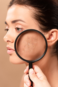 cropped view of man holding magnifier near girl with acne isolated on beige