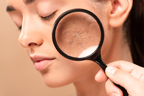 cropped view of man holding magnifier near young woman with problem skin isolated on beige