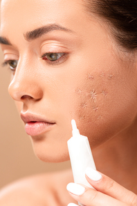 close up of girl holding treatment cream near face with problem skin isolated on beige