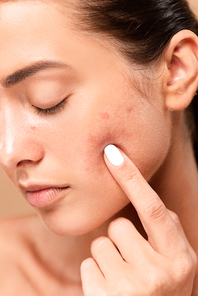 young woman pointing with finger at face with problem skin isolated on beige