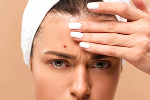 cropped view of young naked woman with pimple on face touching forehead isolated on beige