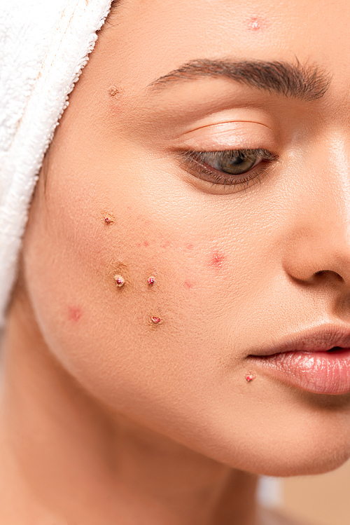 close up of girl with acne on face isolated on beige