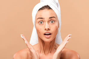 surprised nude girl in towel with acne on face looking at camera isolated on beige