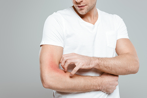 Cropped view of man scratching hand with allergy isolated on grey