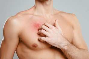 Partial view of man scratching skin with allergy isolated on grey