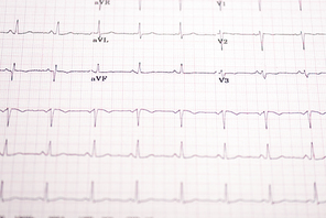 Selective focus of electrocardiogram on paper