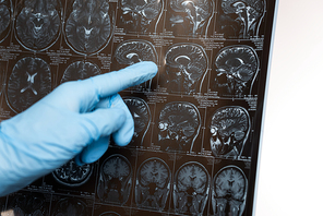 Cropped view of doctor pointing on magnetic resonance imaging of brain isolated on white, alzheimer disease concept